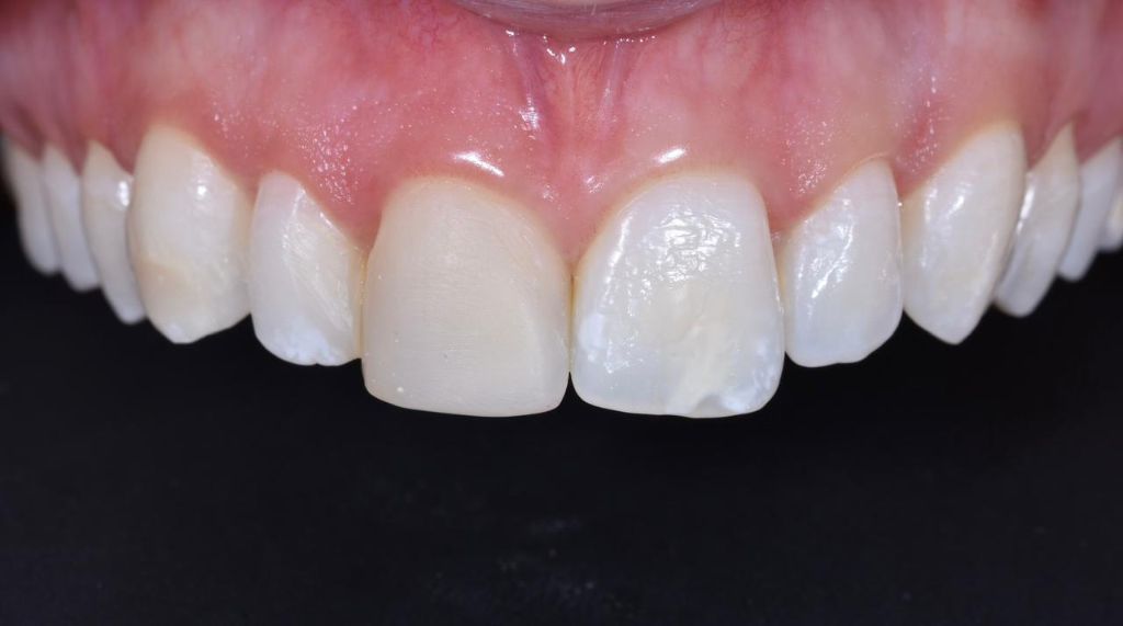 Antes - Carillas de Resina Compuesta - Dra. Ivanova Guerrero CDMX