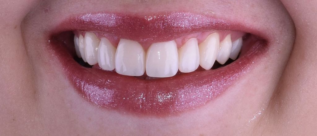 Después Close-up - Carillas de Resina Compuesta - Dra. Ivanova Guerrero CDMX