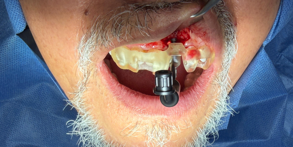 Caso 3 - Cirugía de Implantes - Dra. Ivanova Guerrero CDMX