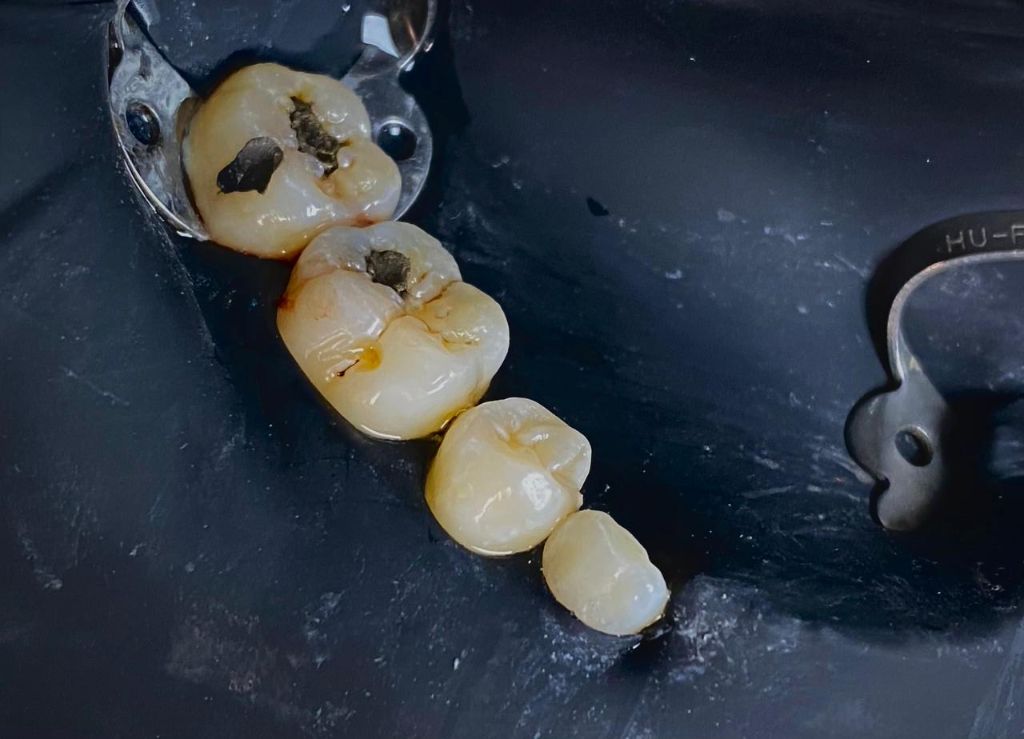 Antes - Coronas Dentales - Dra. Ivanova Guerrero CDMX