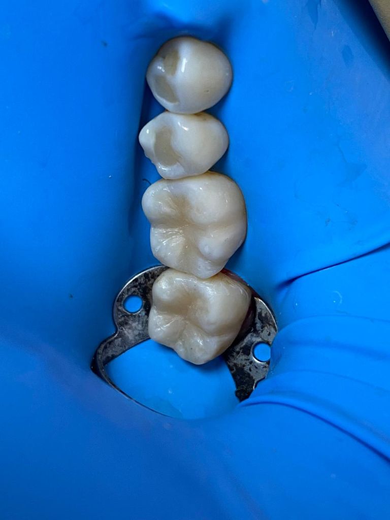 Después - Rehabilitación en Resina Compuesta - Dra. Ivanova Guerrero CDMX